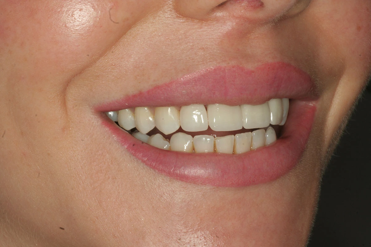 Veneers Case 2