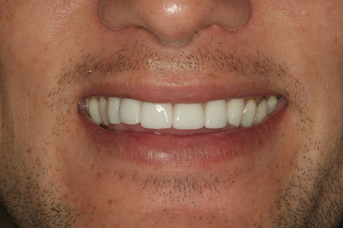 Veneers Case 1