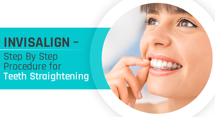 Invisalign – Step By Step Procedure for Teeth Straightening