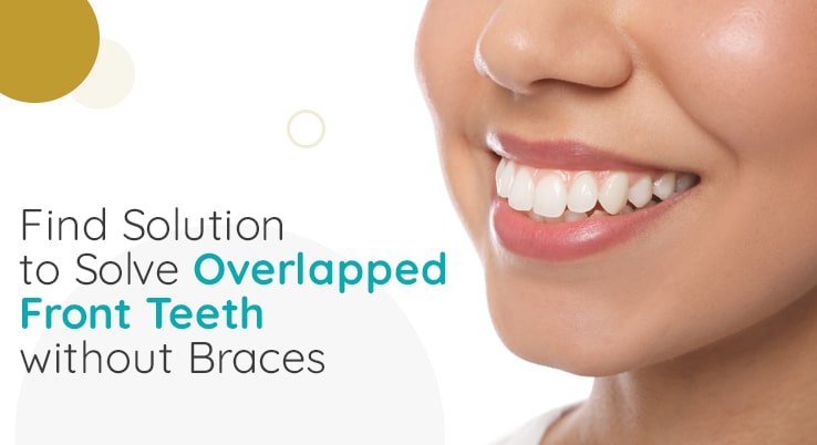 Find Solution to Solve Overlapped Front Teeth without Braces